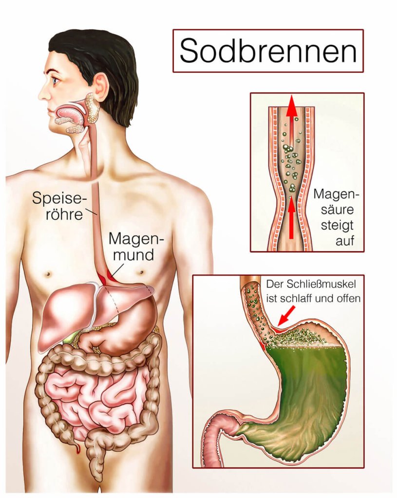 Darstellung Speiseröhre und Magen bei Sodbrennen
