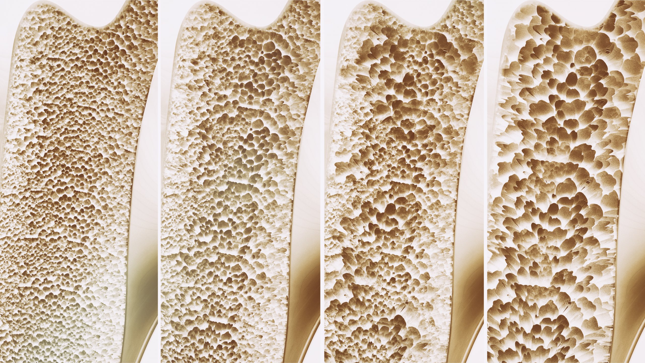 Osteoporose – die unterschätzte Volkskrankheit